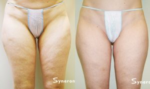 Before and after slender less discolored and freckled legs of a woman