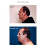 A man standing at a side view showing his neck liposuction before and after photos with a blue and white background