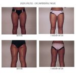 A woman showing her before and after photos of her Laser Liposuction on her legs and buttocks in a grey background in black and pink underwear
