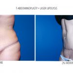 A woman showing her before and afters of her liposuction abdomen with a blue background