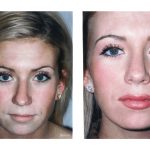 A young lady shown with a before and after of a nose job starring straight at the camera
