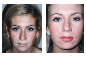 A young lady shown with a before and after of a nose job starring straight at the camera