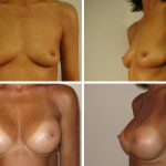 Before and after photos of a woman whom has had Breast Implants with a grey background