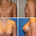 A blonde woman posing for her before and after photos of her breast implants with a grey and blue background