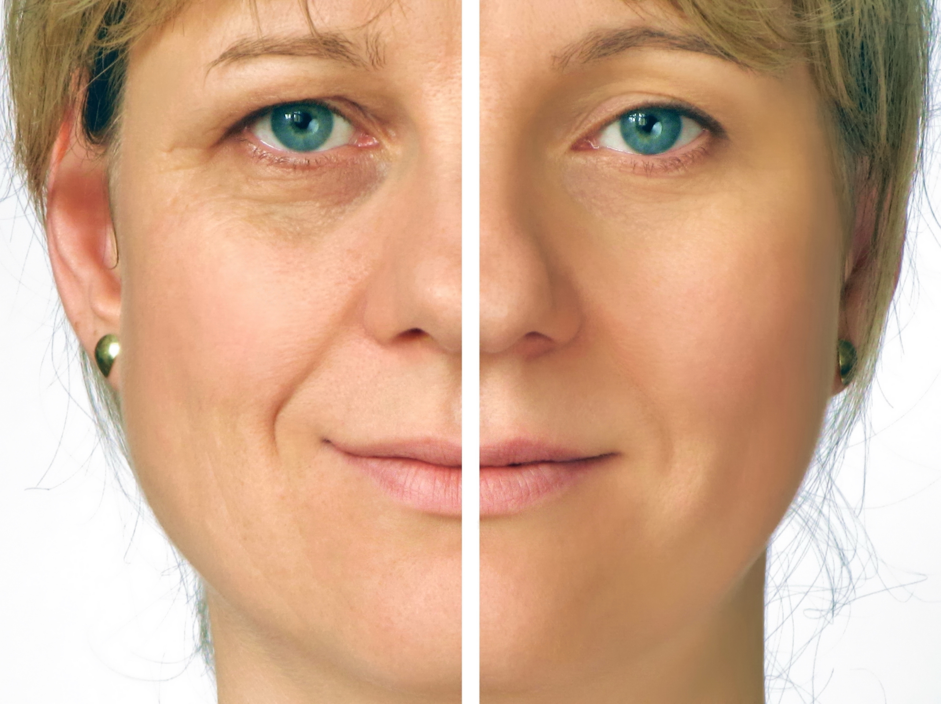 Face Lift - Before and After of Middle Aged Woman's Face Correcting Wrinkles