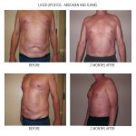 A gentleman stadning for before and after photos of his laser liposuction on his flanks and abdomen
