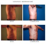 Before and after photos showing a man that has had liposuction on his abdomen and flanks with a blue and grey background