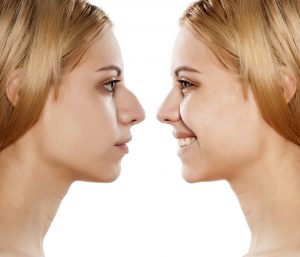 Rhinoplasty - Before and After of plastic surgery of the nose