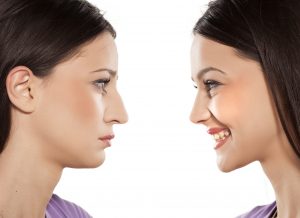 A woman pictured facing herself wit a frown for the nose she wants corrected and an after of her new nose that she likes