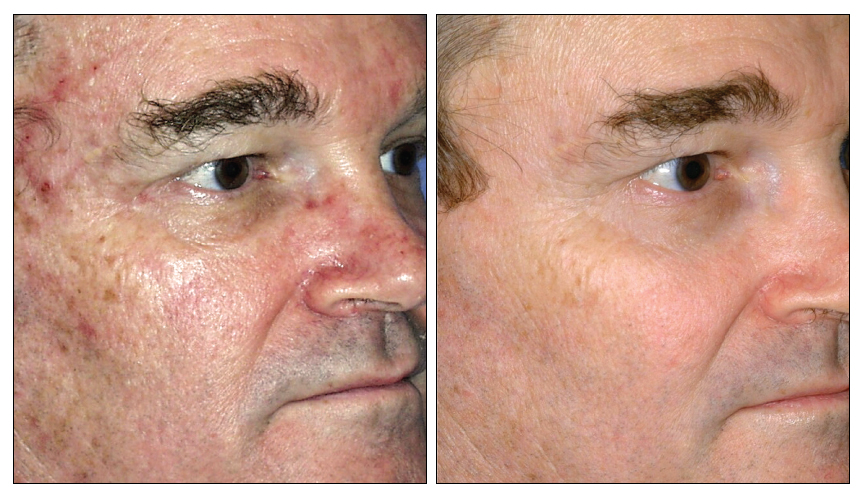 sciton-laser-skin-before-after-1 - Carolina Coastal Plastic Surgery