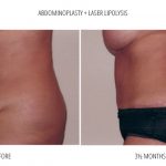A woman showing her abdomen in a before and after photo showing the results of her tummy tuck and liposuction in a grey background