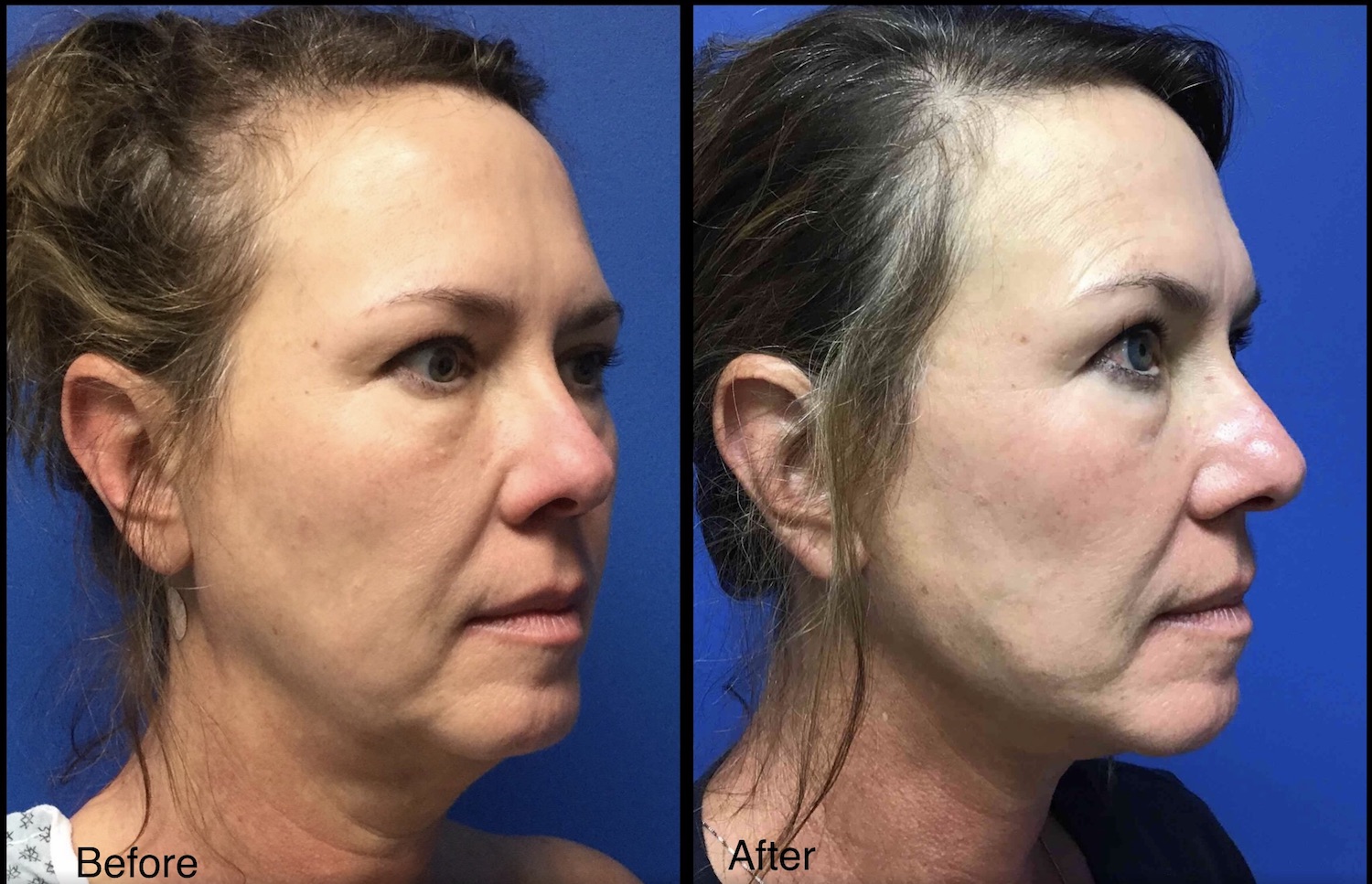 Woman With Face And Neck Lift Before And After Carolina Coastal Plastic Surgery