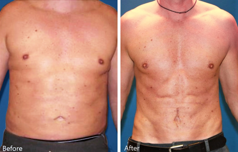 Male Love Handle Liposuction Before & After Photos Charlotte North