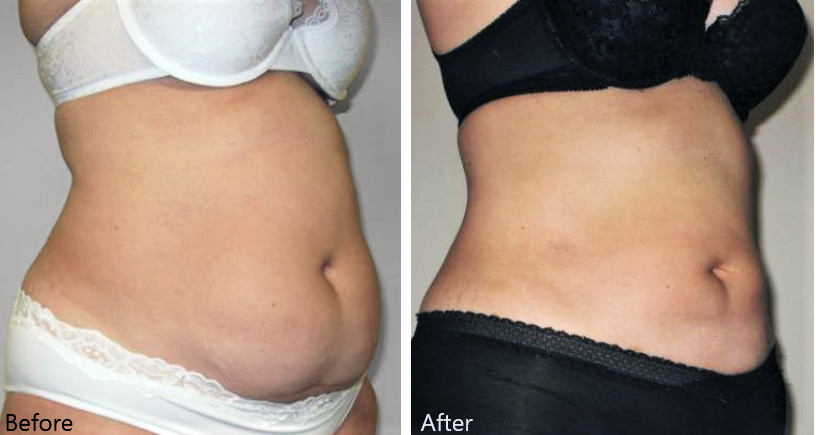 Laser Liposculpting Breast Reduction Could be for You - Carolina Coastal  Plastic Surgery