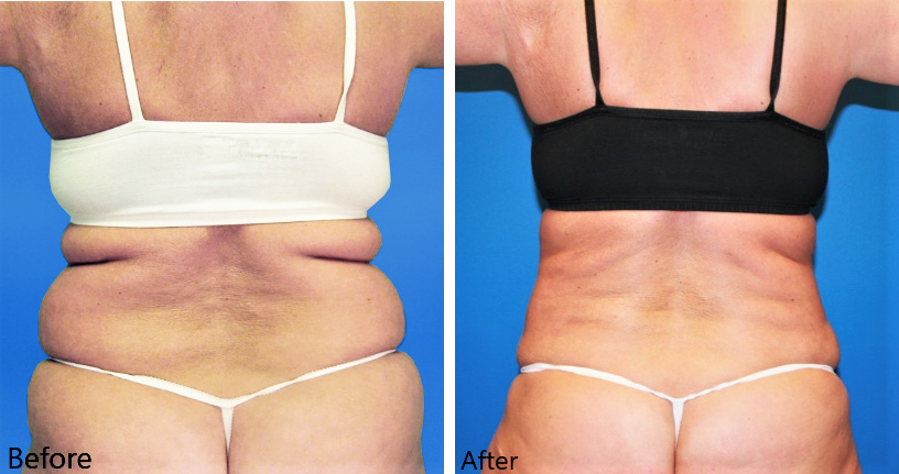 Laser Liposculpting Breast Reduction Could be for You - Carolina Coastal  Plastic Surgery